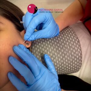 Punción seca fisioterapia