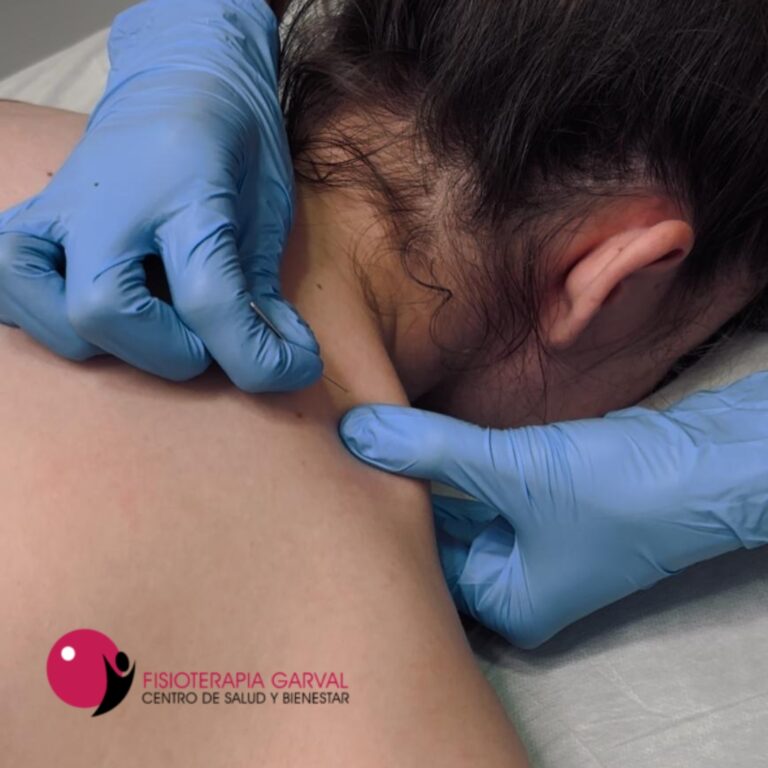 Punción seca fisioterapia