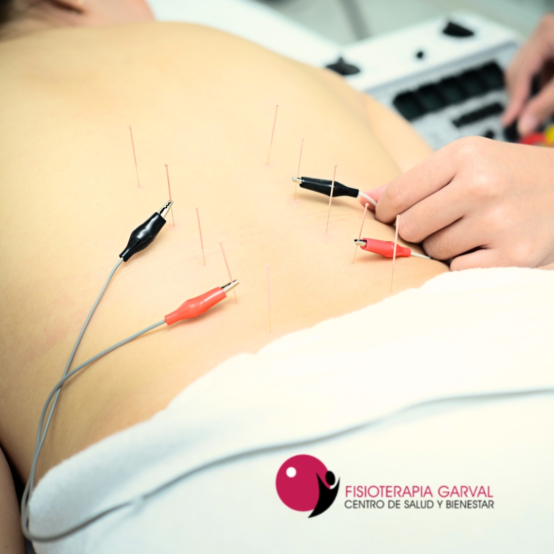 Electroacupuntura en fisioterapia